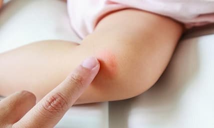 علاج الطفح الجلدي المفاجئ عند الاطفال